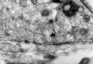 M, 1y. | epidermolysis bullosa … junctional type … rudimentary hemidesmosomes, missing anchoring fibrils M, 1y. | epidermolysis bullosa … junctional type … rudimentary hemidesmosomes, missing anchoring fibrils